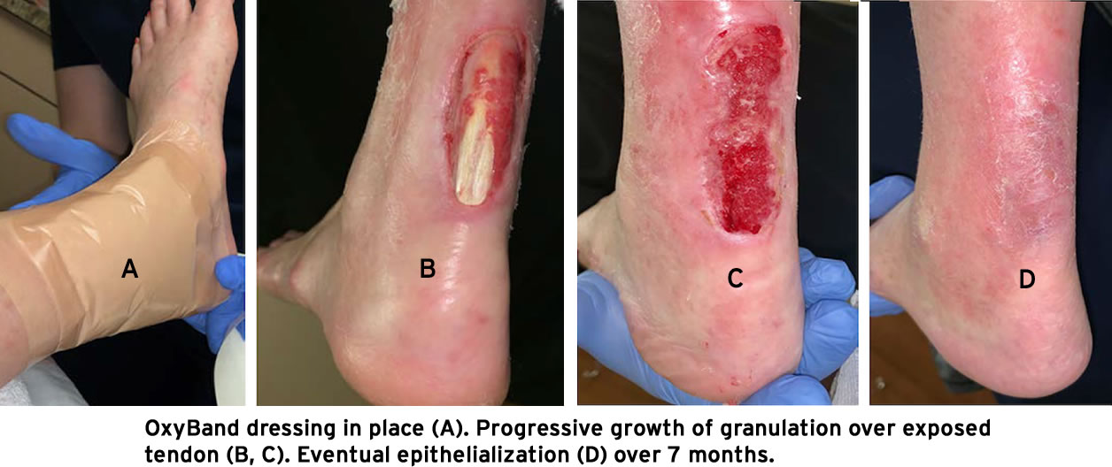Use of OxyBand published in Vascular Disease Management, "The Achilles Tendon Vascular Flow is Achilles’ True Weakness" Use of OxyBand published in Vascular Disease Management, "The Achilles Tendon Vascular Flow is Achilles’ True Weakness"